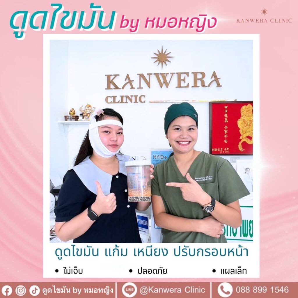 ขั้นตอนการดูดไขมัน เมื่อไขมันถูกสลายแล้ว แพทย์จะใช้ท่อเล็ก ๆ (Cannula) สอดเข้าไปดูดไขมันออก โดยจะพยายามดูดให้ทั่วถึงและสมูทที่สุด เพื่อให้ผิวเรียบ ไม่เป็นคลื่นหรือเป็นรอยบุ๋ม