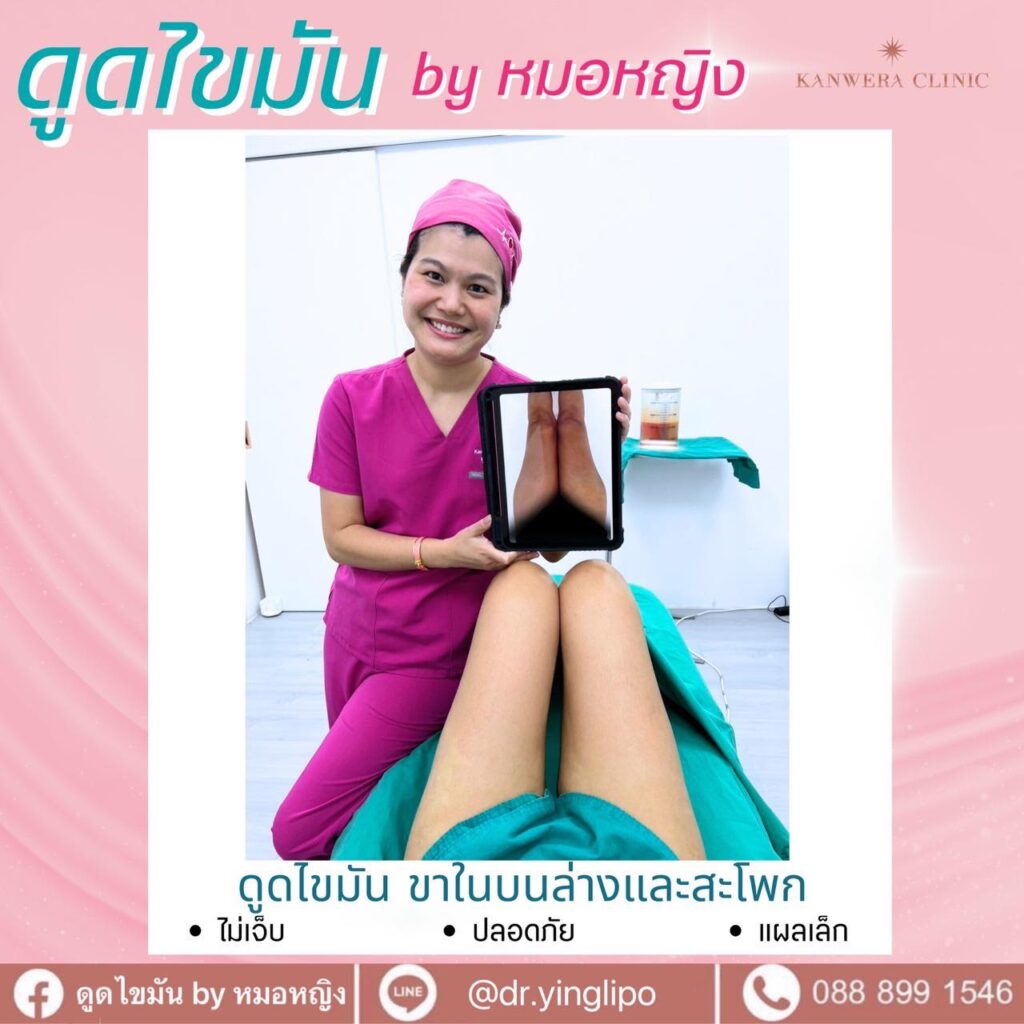 ดูดไขมัน มีวิธีไหนบ้าง การดูดไขมัน (Liposuction) เป็นหัตถการที่ช่วยกำจัด และลดปริมาณไขมันส่วนเกินอย่างถาวร โดยเป็นการกำจัดเซลล์ไขมันใต้ชั้นผิวหนัง เพื่อช่วยให้ได้รูปร่างตามที่ต้องการ